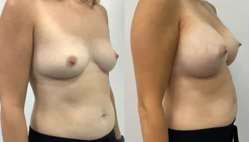breast augmentation colombia 365-2-min