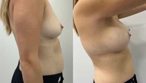 breast augmentation colombia 365-3-min