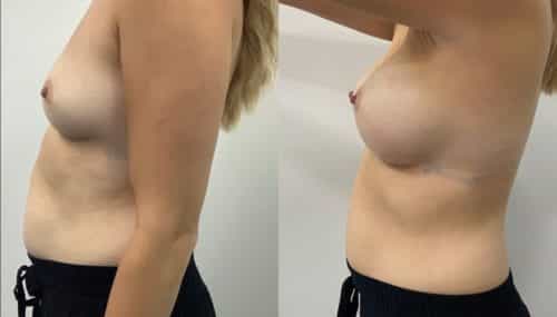 breast augmentation colombia 365-5-min