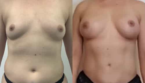 breast augmentation colombia 366-1-min