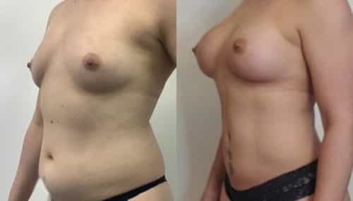 breast augmentation colombia 366-2-min