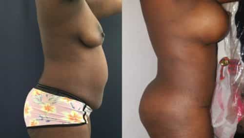 breast lift colombia 205 -2-min