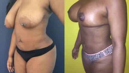breast lift colombia 206-2-min