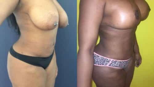 breast lift colombia 206-3-min
