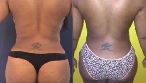 breast lift colombia 206-4-min