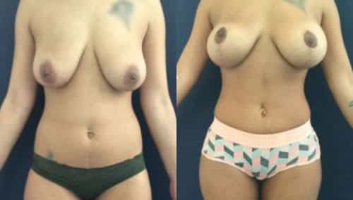 breast lift colombia 207-1-min