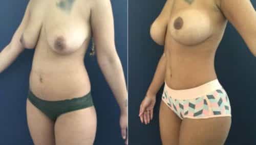breast lift colombia 207-2-min