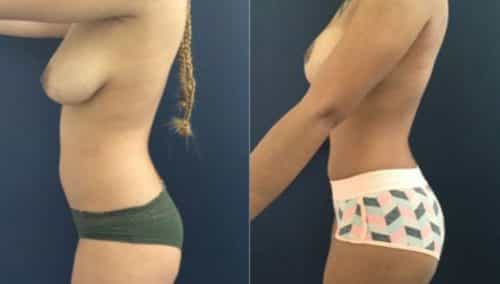 breast lift colombia 207-3-min