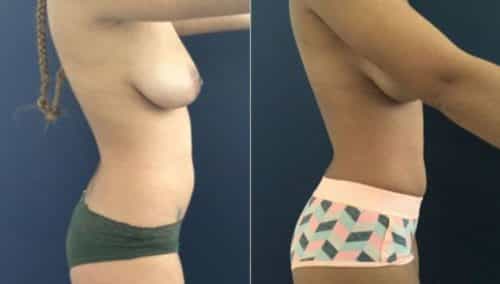 breast lift colombia 207-5-min