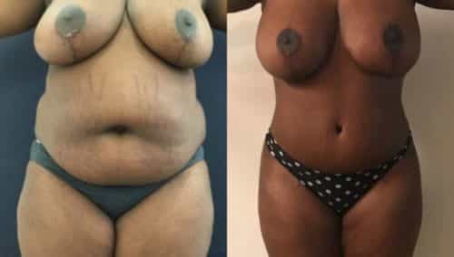 breast lift colombia 209-1-min
