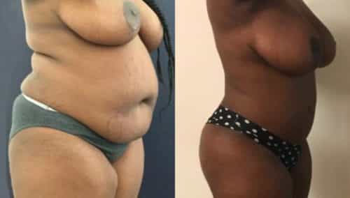 breast lift colombia 209-2-min
