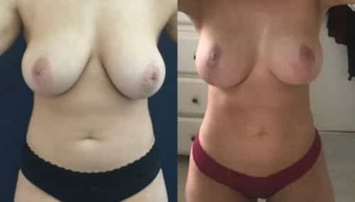 breast lift colombia 215-1-min