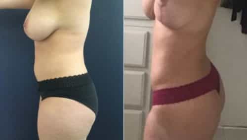 breast lift colombia 215-2-min