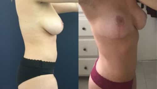 breast lift colombia 215-3-min