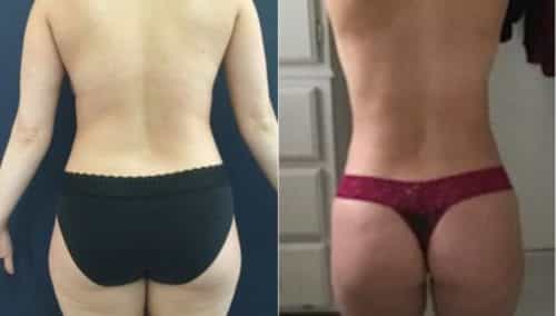 breast lift colombia 215-4-min