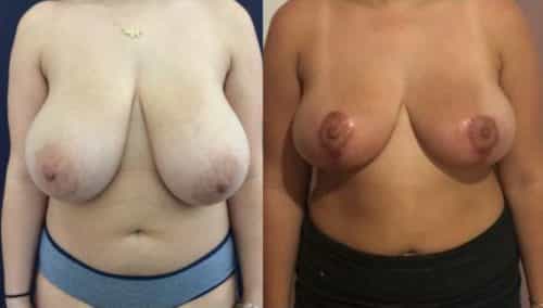 breast lift colombia 224-1-min