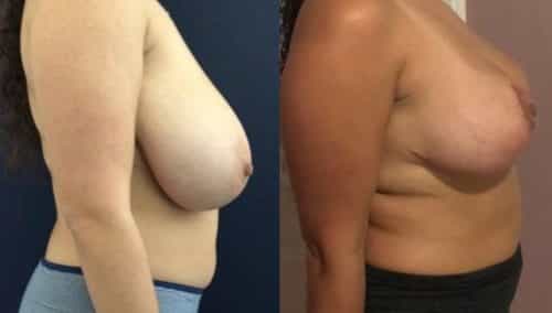 breast lift colombia 224-5-min