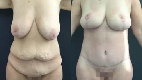 breast lift colombia 226-1-min