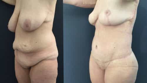 breast lift colombia 226-2-min