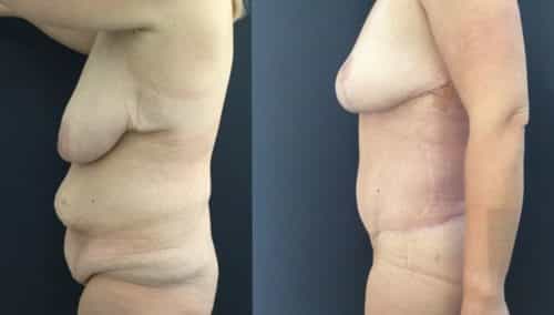 breast lift colombia 226-3-min