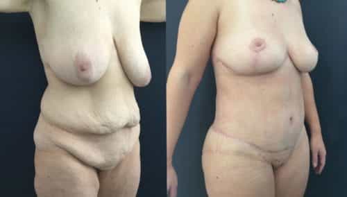 breast lift colombia 226-4-min
