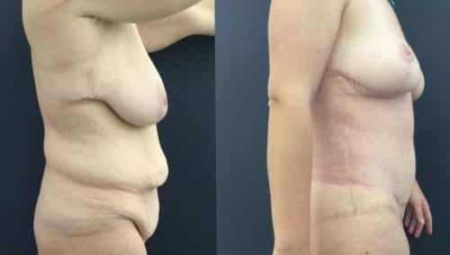 breast lift colombia 226-5-min