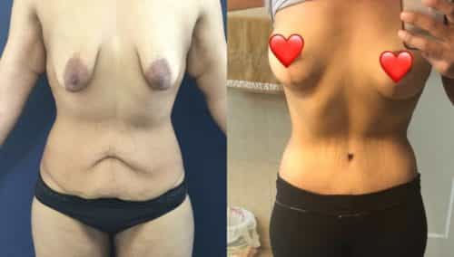 breast lift colombia 236-1-min