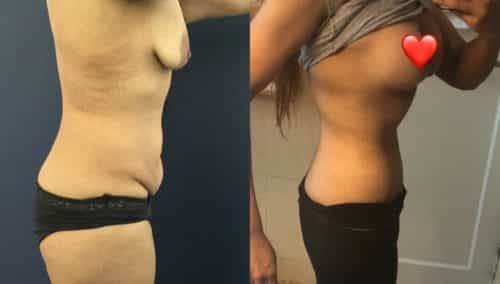 breast lift colombia 236-2-min