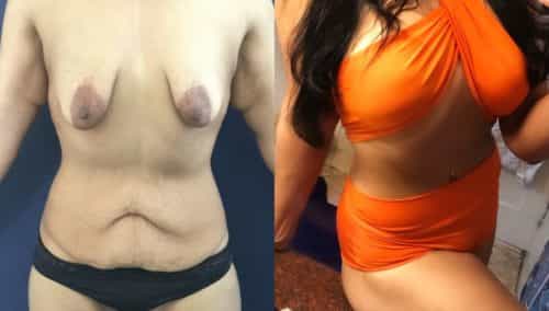 breast lift colombia 236-3-min