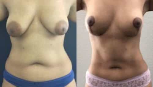 breast lift colombia 244-1-min