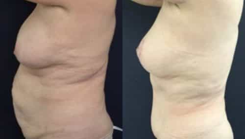 breast lift colombia 246-3-min