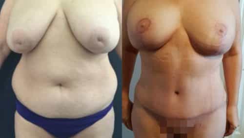 breast lift colombia 252-1-min