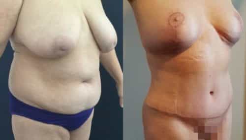 breast lift colombia 252-3-min