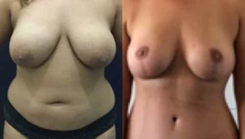 breast lift colombia 271-1-min