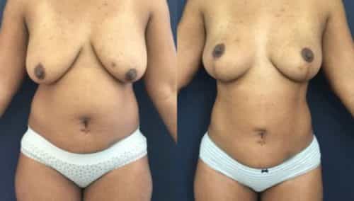 breast lift colombia 273-1-min