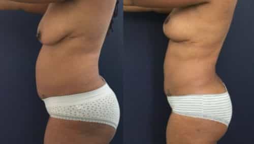 breast lift colombia 273-2-min