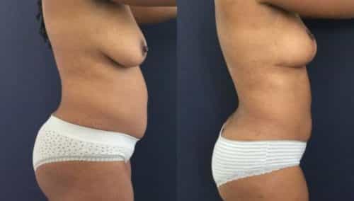 breast lift colombia 273-3-min