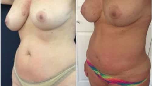 breast lift colombia 274-2-min