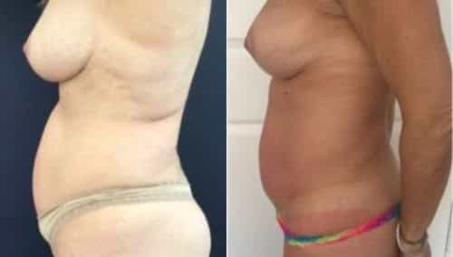 breast lift colombia 274-3-min