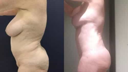 breast lift colombia 282-2-min