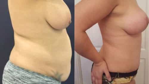 breast lift colombia 288-5-min