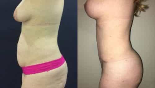 breast lift colombia 297 -2-min