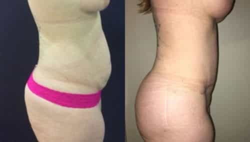 breast lift colombia 297 -3 (1)-min