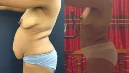 breast lift colombia 299-3-min