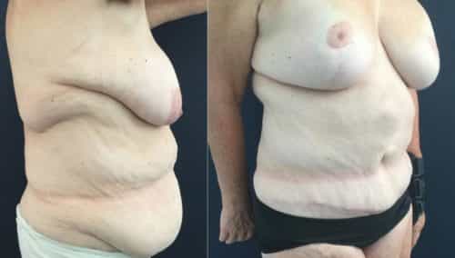 breast lift colombia 322-3-min