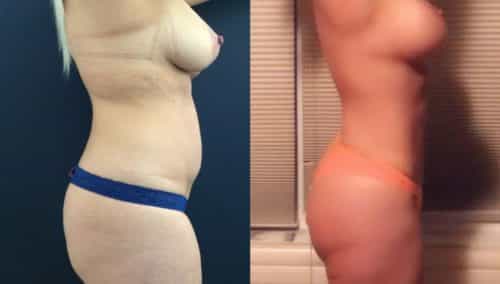 breast lift colombia 327 - 2-min