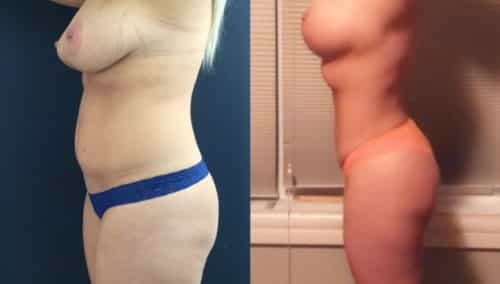 breast lift colombia 327 - 3-min