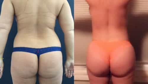 breast lift colombia 327 - 4-min