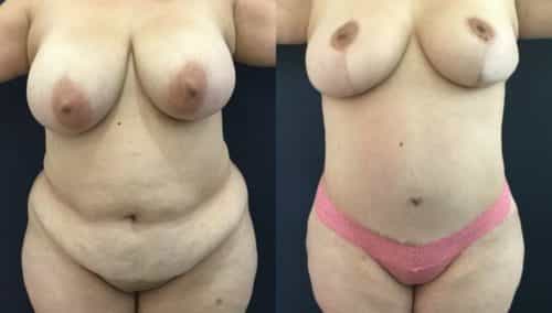 breast lift colombia 334-1-min