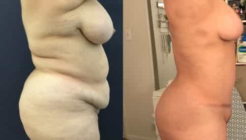 breast lift colombia 334-3-min